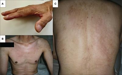 New-onset dermatomyositis following COVID-19: A case report